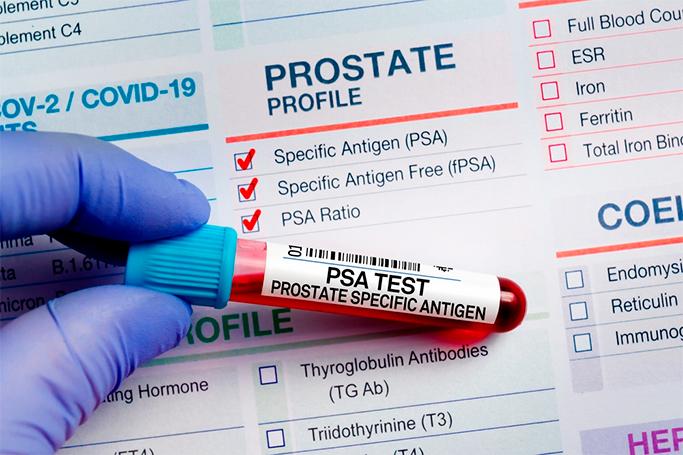 Prostat xərçəngi diaqnozunda inqilab